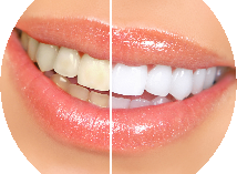 Teeth whitening